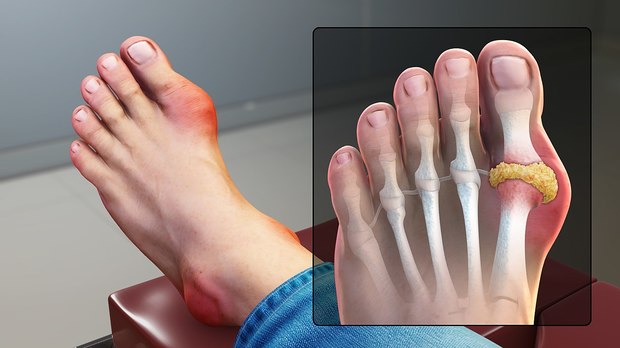 What Are The Signs Of Gout And How Is It Treated   E0C0F028 3B40 4296 A514 807D08BDC69B 